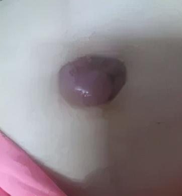 肚臍里長了個“球”，怎么就癌癥晚期了？