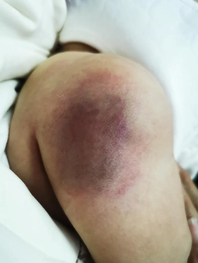 打预防针会长“血管瘤”？婴儿胳膊红肿2个月不退，医生一语道出真相