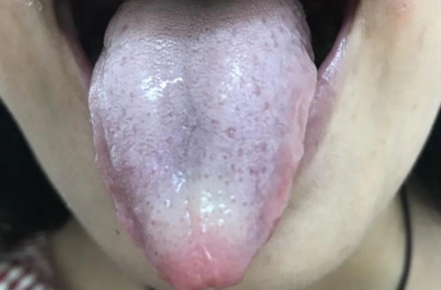一补就上火？舌头有齿痕，舌苔比较厚？这7种舌象不要着急进补