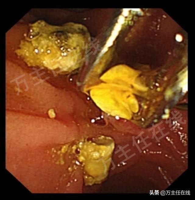 孕34周腹痛入院，多科通力合作挽救胆管结石伴胆管炎妊娠晚期孕妇