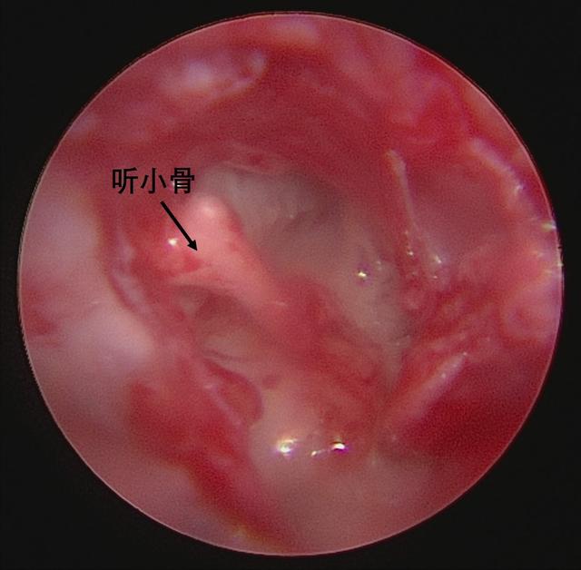 耳朵里长了个小珍珠