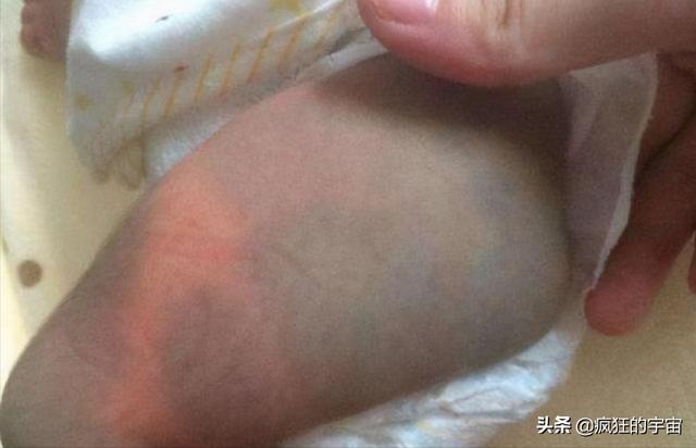 为啥很多刚出生的婴儿屁股上都有“淤青“？答案终于来了