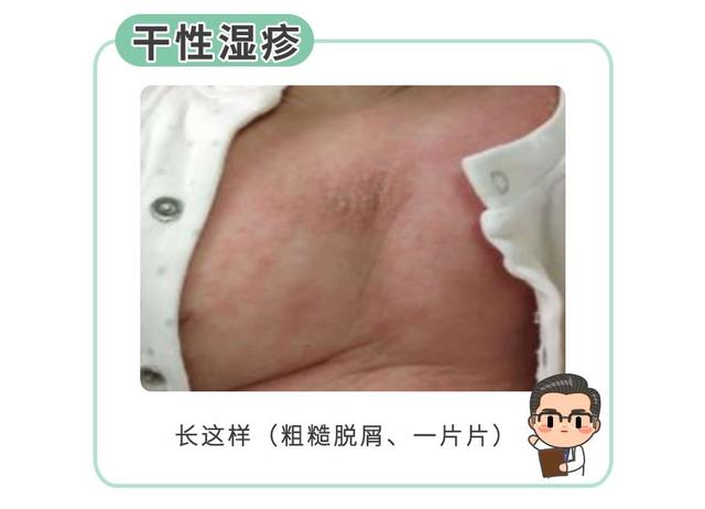 不少妈妈会把热疹和干性湿疹混淆,干性湿疹高发,记住几点就够了_健康