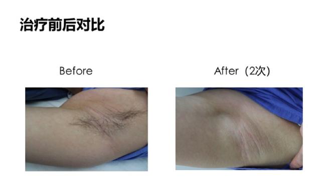 夏日就要来了 脱毛你需要清亮的 隆鼻失败修复