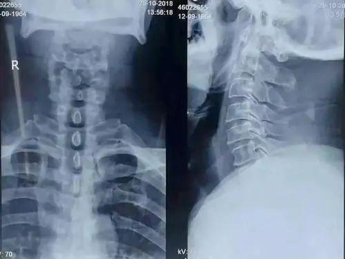 颈椎综合征，你不能再随便按摩了