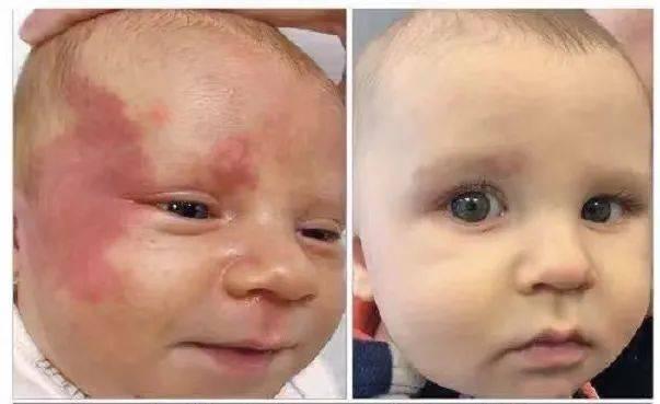 困扰爸妈的难题，小孩出现鲜红斑痣该咋办？难道与饮食有关？