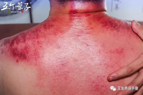 刮痧治壮汉，艾灸补虚人！一起来看看刮痧与艾灸的不同之处