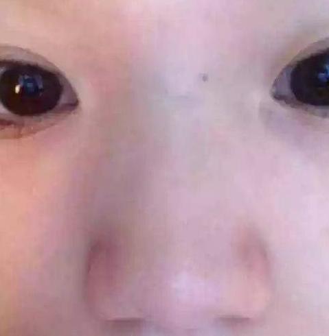 宝宝鼻梁有青筋 小儿推拿来护理