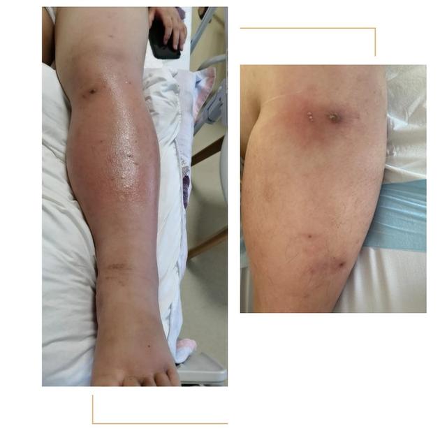 被蚊子咬了一口，孕妇紧急剖宫产保命