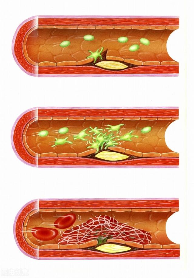 70岁以上的老年人要不要吃阿司匹林？