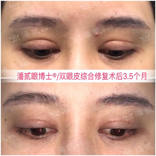 開了眼角後悔不已的案例 內眼角過大 露紅 括號 疤痕重 顯假 Kks資訊網