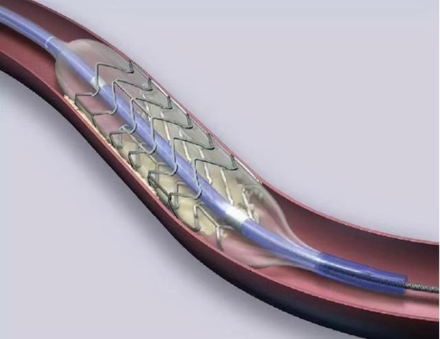 冠状动脉狭窄50%，不放支架怎样治？这里为您答疑解惑