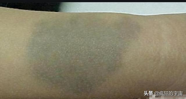 为啥很多刚出生的婴儿屁股上都有“淤青“？答案终于来了