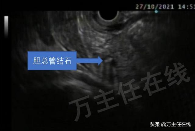 孕34周腹痛入院，多科通力合作挽救胆管结石伴胆管炎妊娠晚期孕妇