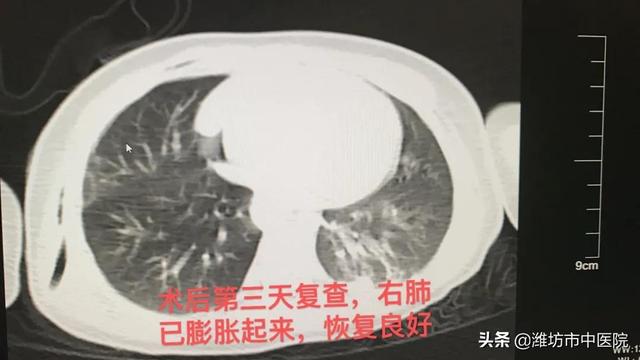 16个月宝宝右肺神秘“消失”