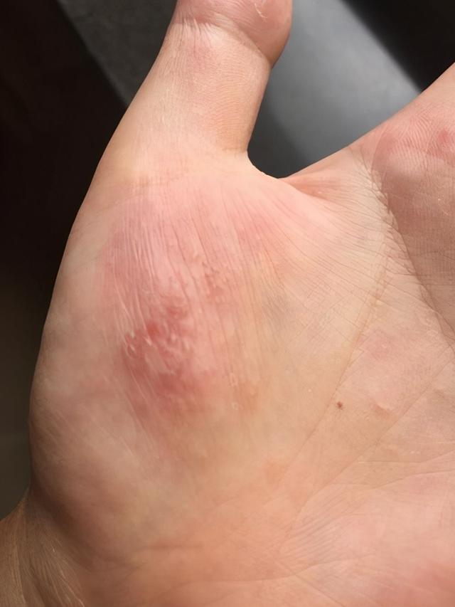 一到夏季手上就长透明"小水泡",还总痒,该怎么办?_健康症状网