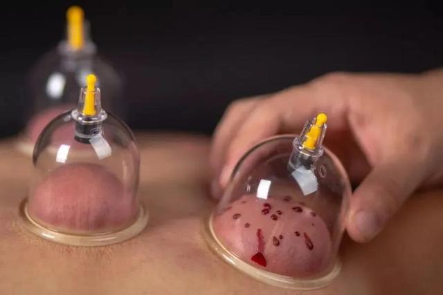 中医放血治疗，有没有危险？