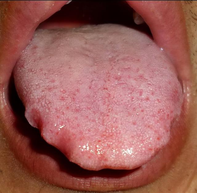 舌头胖大，有齿痕是怎么回事？中医说你脾虚了