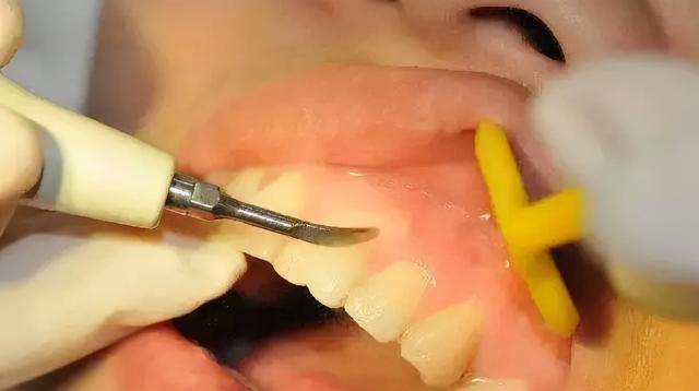 洗牙大概要多少钱（洗牙普通200深度3000，有什么区别）