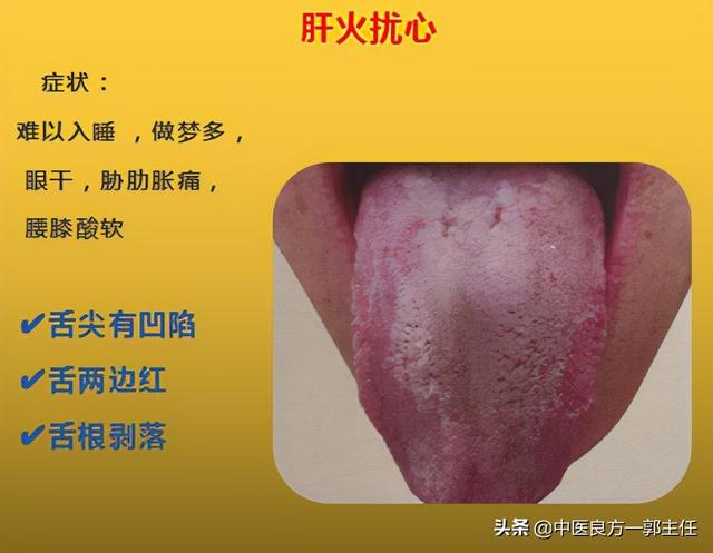 12种“热”藏于体内，反应的舌象、症状各不相同，自查便知