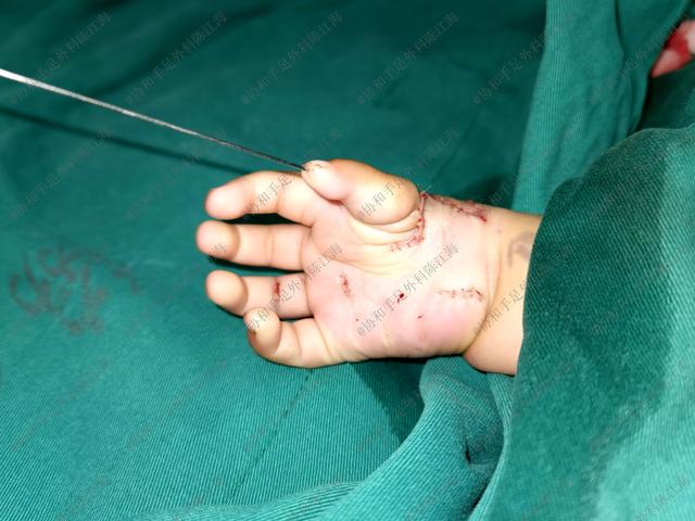 怎么判断宝宝的手是III型还是IV型的拇指发育不良？