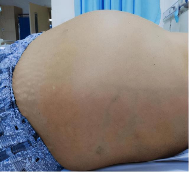 肝癌腹水难消，只能反复抽腹水？老中医经验分享，应对顽固腹水