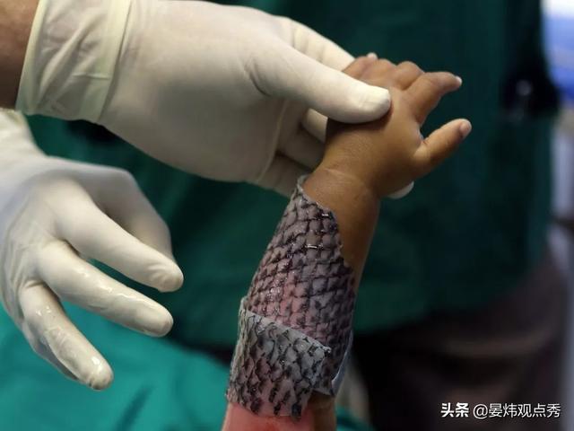 医院回应让烧伤病人移植猪皮被烧伤的患者,为啥被"植"鱼皮? - 淘金网