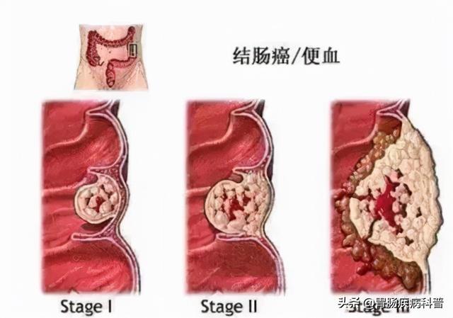 晚期肠癌到底有多可怕？34岁帅哥，患癌1年变干瘦老人…