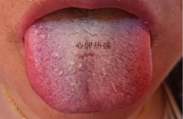 舌头胖大用参苓白术丸没用？胖大舌也分三种，教你如何对症调理