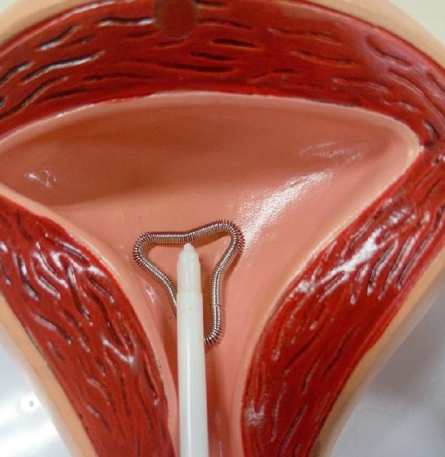 避孕环是什么原理避孕环节育环宫内节育器是个啥