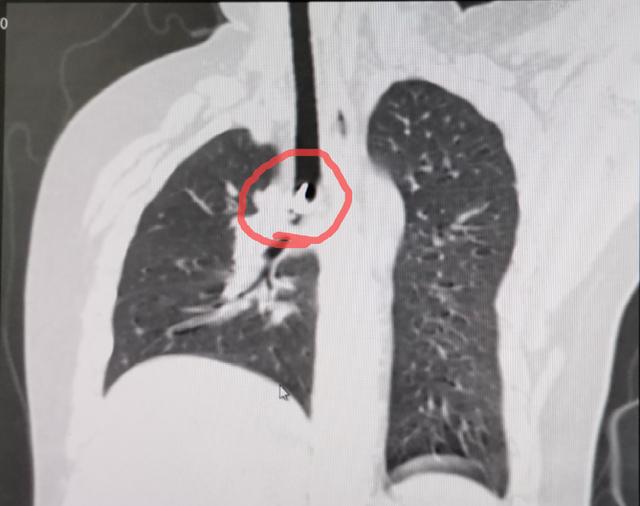 9岁男孩玩图钉，不小心吸入气管