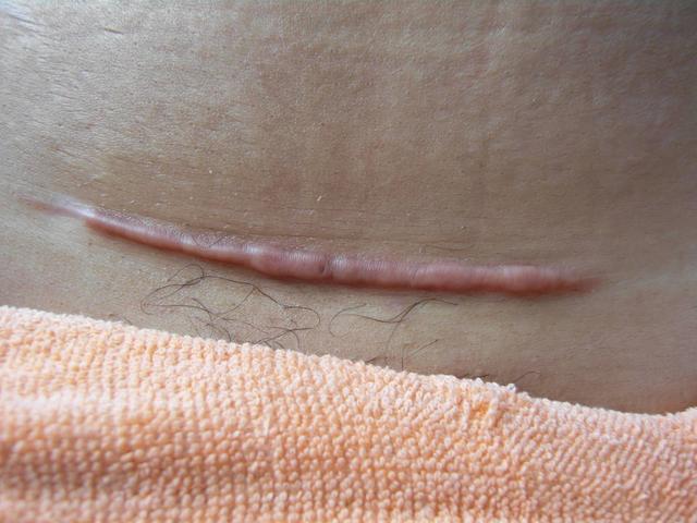 剖腹产刀口增生有什么影响？