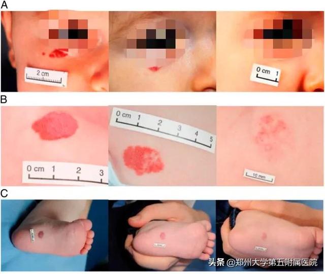 治疗宝宝的“红胎记”，您做对了吗？