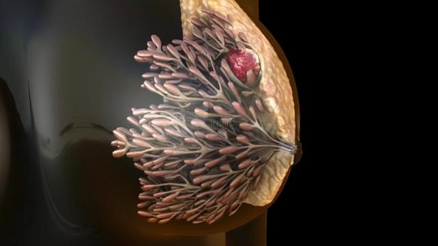 豆浆是乳腺癌 帮凶 含异黄酮还致 癌 豆浆到底能不能喝 太阳信息网