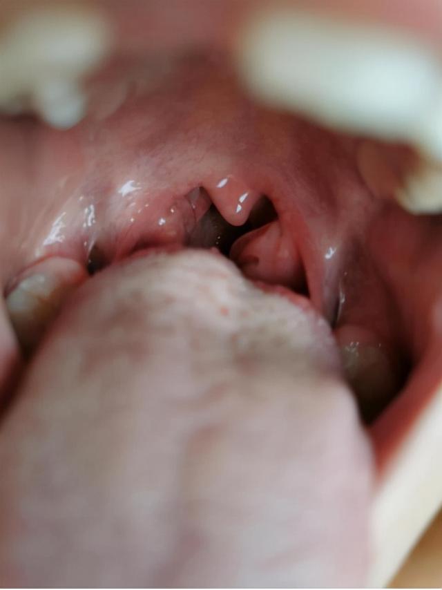 导致孩子过敏的罪魁祸首——肠漏症