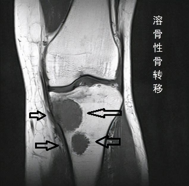 什么樣的疼痛應該小心是骨轉移？