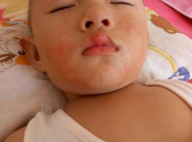 宝宝又出现“湿疹”，这“3大禁忌，9个注意”宝妈一定要知道！