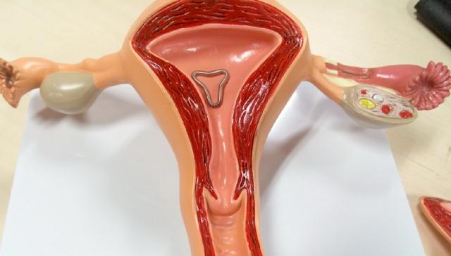 避孕环是什么原理（避孕环、节育环、宫内节育器是个啥）