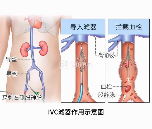 孕期得了静脉血栓栓塞症，怎么办