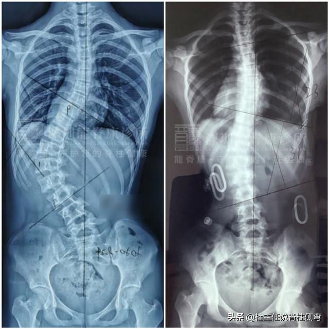 孩子食欲暴涨、脊柱侧弯，可能是得了这种“罕见病”