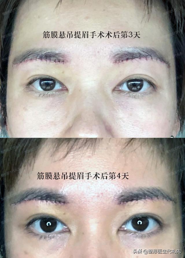 提眉手术多久疤痕会完全消失 来看看提眉手术后的恢复情况 今日热点