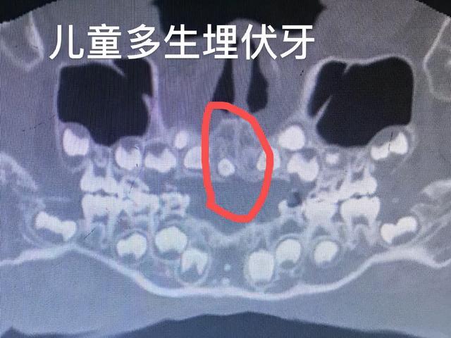 「备孕期」牙病患者需要注意这些