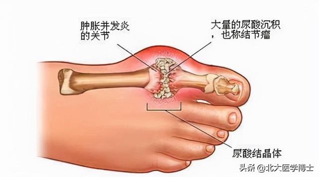 痛风患者为啥多痰湿？用麻杏苡甘汤和苯溴马隆治？哪个效果好？
