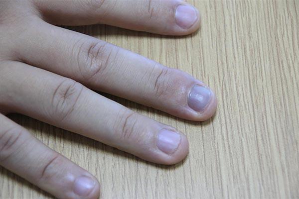 指甲上的月牙少，代表身体不健康？为什么有的人多，有的人少？