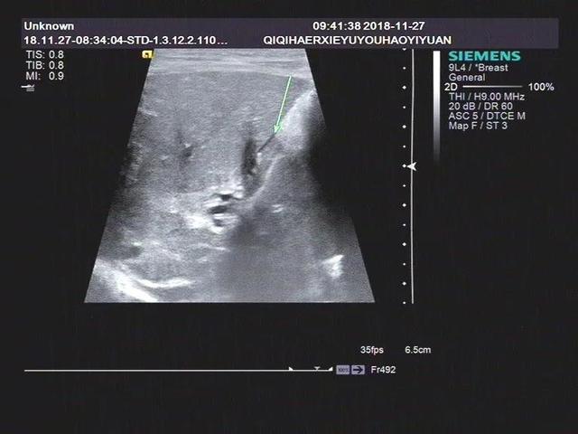 浅析幼儿黄疸之胆道闭锁的超声表现