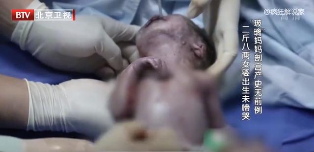 身高89厘米，体重58斤，“玻璃”妈妈冒死生下女儿！纪录片