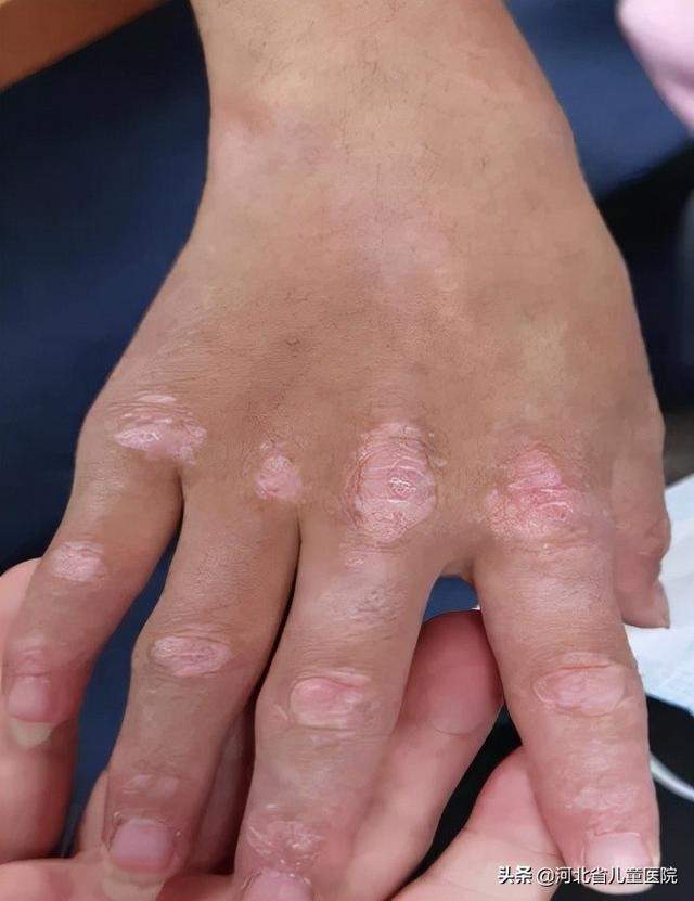 要重视！孩子身上多处斑疹和皮损多达6年
