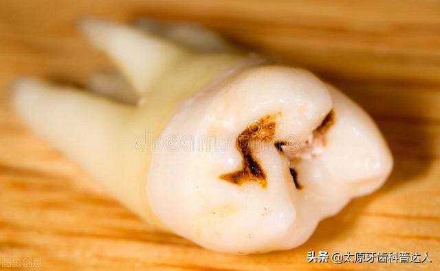 牙齿剧烈疼痛，有可能是它在搞事情