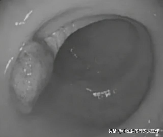 大便正常，腫瘤標志物正常，卻意外發現腸癌！這6類人群盡早檢查