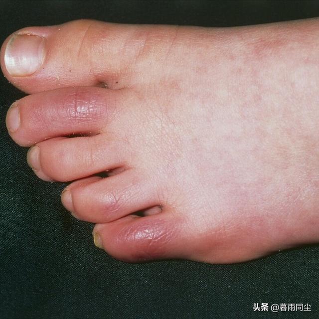 冬季背包客、戶外作業者，如何預防與處理失溫（體溫過低）和凍傷